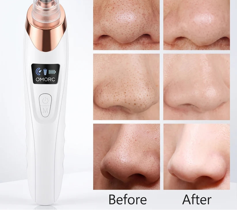 Beautify® Blackheads remover