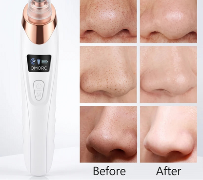 Beautify® Blackheads remover
